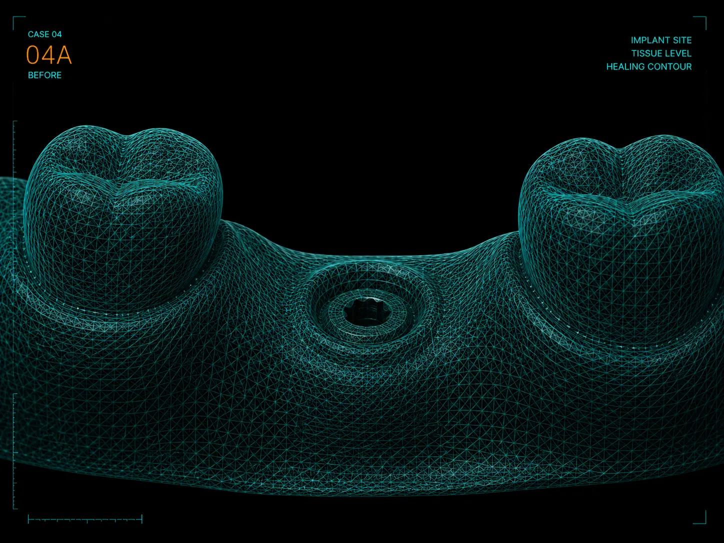 Intake scan with soft tissue healing contour around an implant site