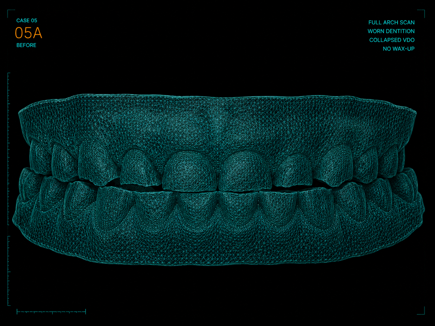 Full-arch intake scan of worn dentition with collapsed vertical dimension before a wax-up