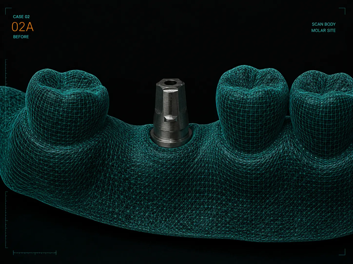 Intake scan showing an implant scan body in a molar site