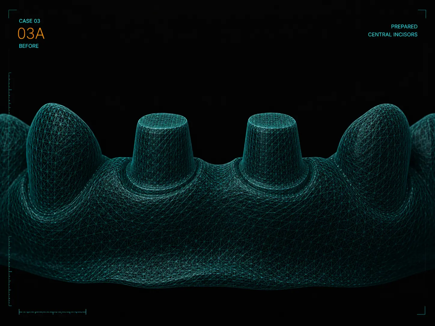 Intake scan of two prepared central incisors for veneers