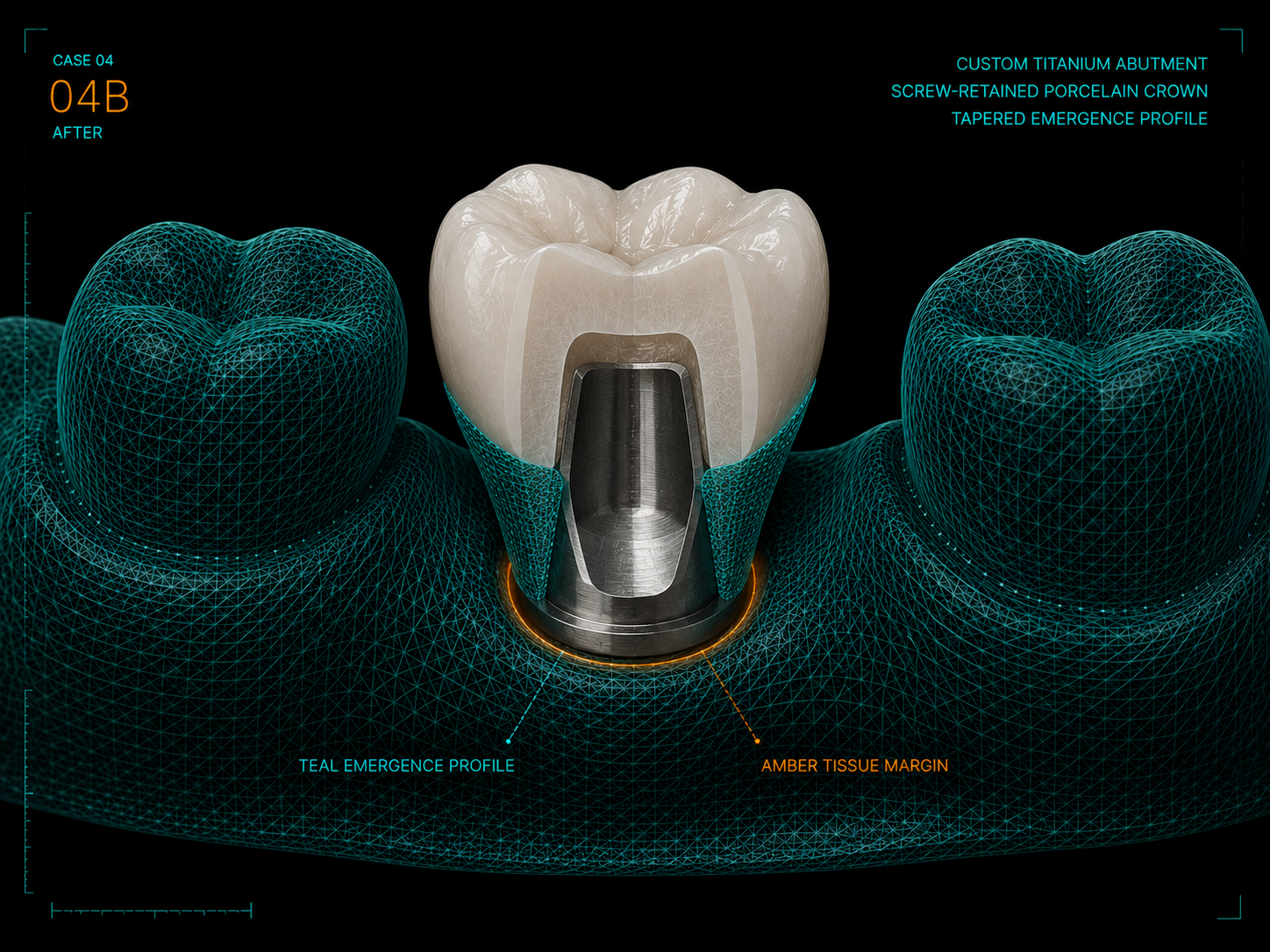 Custom titanium abutment with a screw-retained porcelain crown and tapered emergence profile
