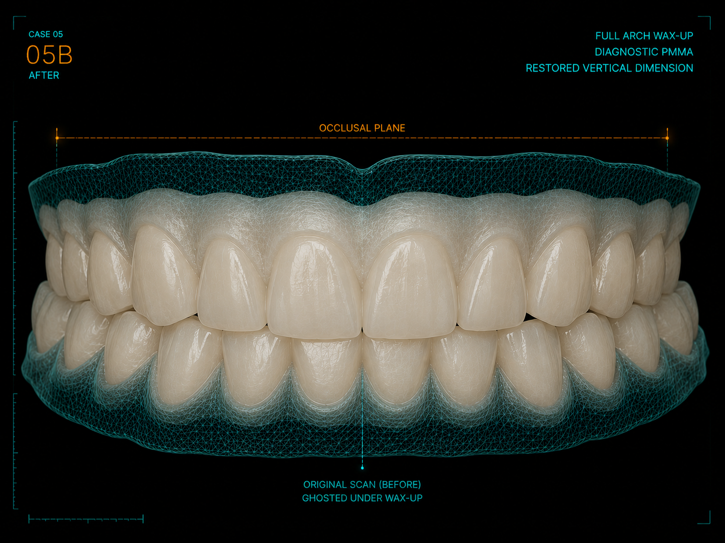 Full-arch diagnostic PMMA wax-up with restored vertical dimension over the ghosted intake scan